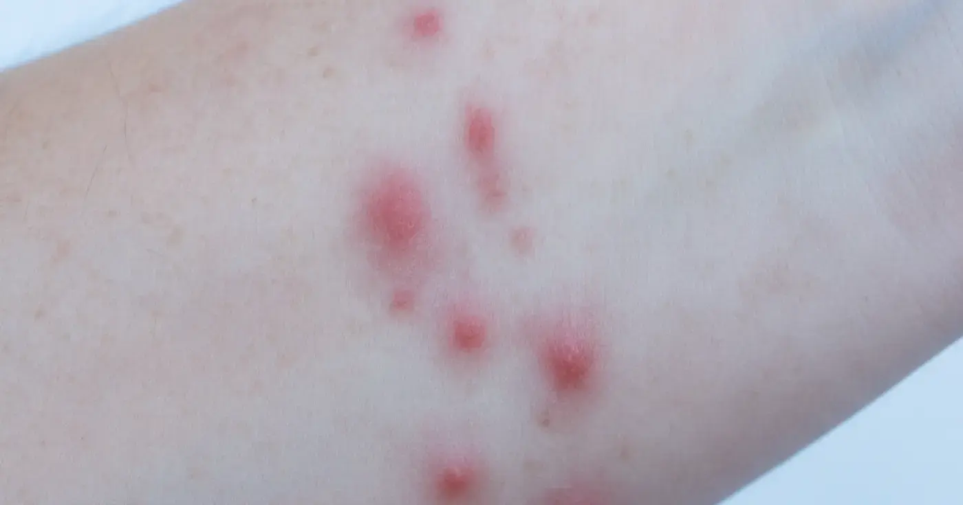 Acute vs. Chronic Urticaria: Differences, Causes, and Treatment