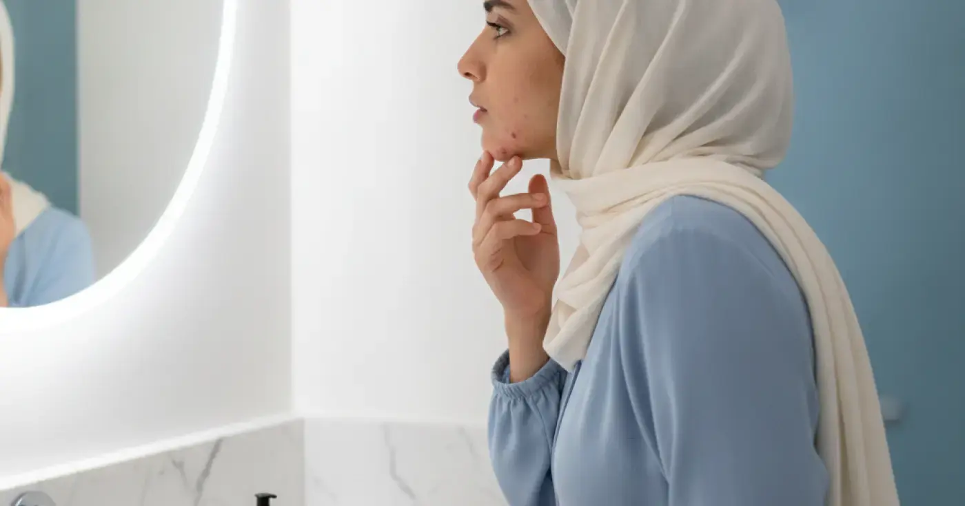 Adult Acne: Why Does It Persist After Teenage Years?