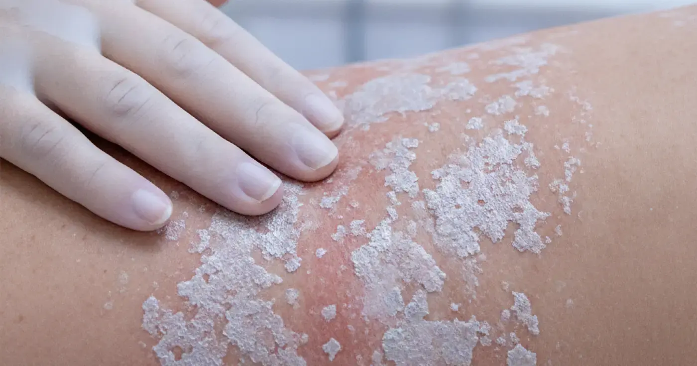 Is Psoriasis Contagious? Key Facts, Causes, and Medical Insights