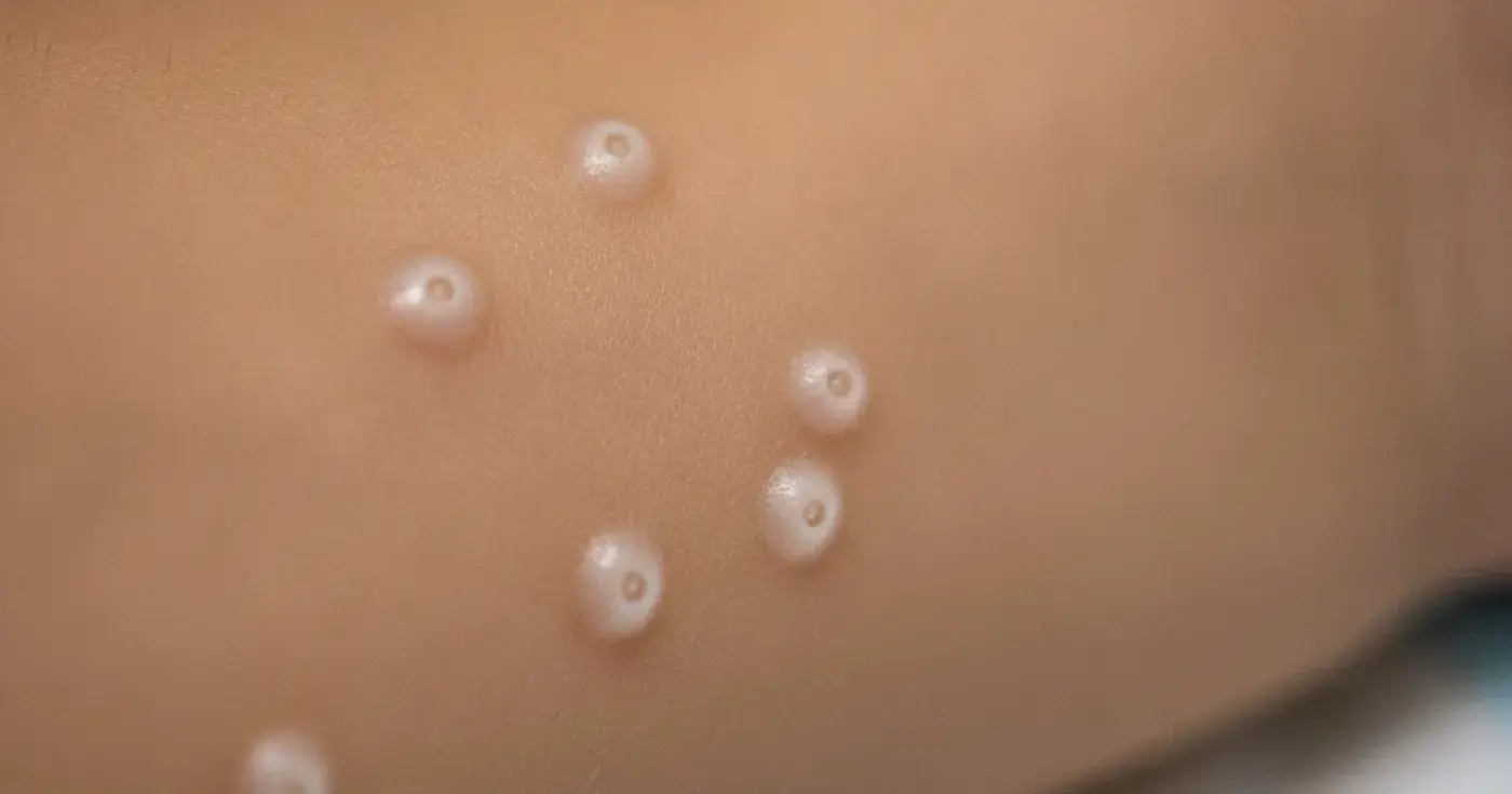 Molluscum Contagiosum: Symptoms, Transmission, and Treatment Options