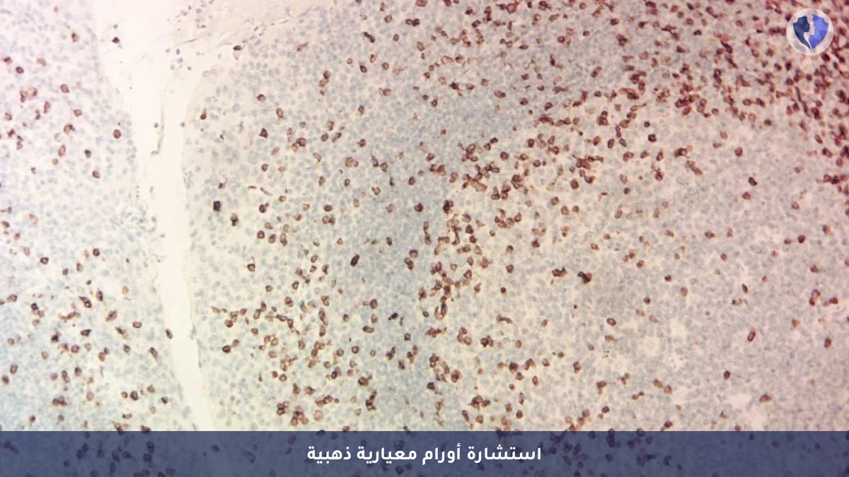 استشارة وتفسير نتائج الكيمياء النسيجية المناعية - 12 علامة (12 Markers) - الرأي الطبي النهائي للأورام