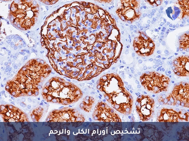 باقة تحليل الكيمياء النسيجية المناعية (CD10) - باقة تشخيص أورام الكلى والرحم