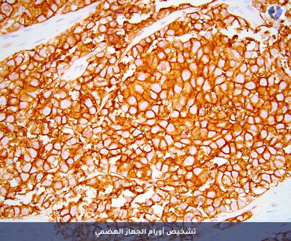 باقة تحليل الكيمياء النسيجية المناعية (CD117) - باقة تشخيص أورام الجهاز الهضمي