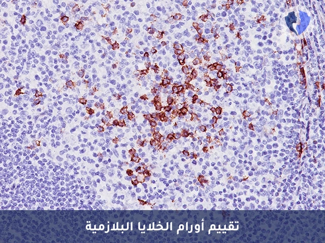 باقة تحليل الكيمياء النسيجية المناعية (CD138) - باقة تشخيص المايلوما واضطرابات البلازما