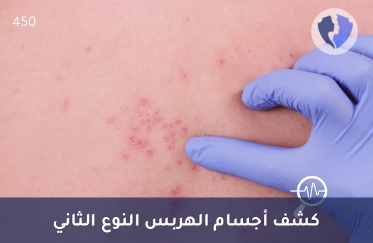 تحليل الأجسام المضادة لفيروس الهربس البسيط النوع الثاني (HSV II IgG) - فحص الأجسام المضادة لهربس 2