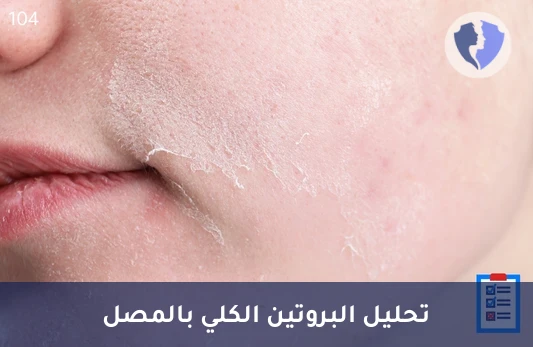 تحليل البروتين الكلي في المصل (Total Protein) - فحص توازن البروتين في جسمك