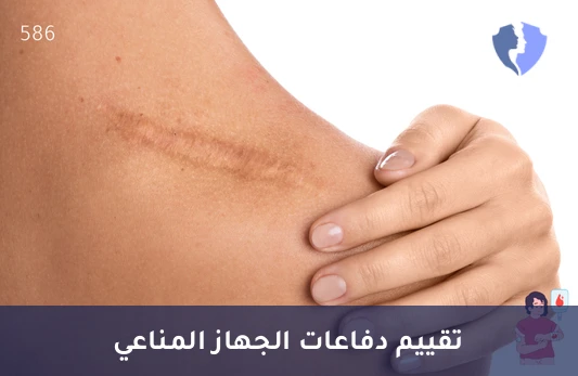 تحليل الخلايا القاتلة الطبيعية (NK Cells) - تقييم قوة خط الدفاع المناعي