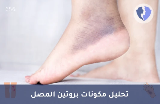 تحليل الفصل الكهربائي لبروتينات المصل (Protein Electrophoresis) - تحليل الفصل الكهربائي لبروتينات الدم