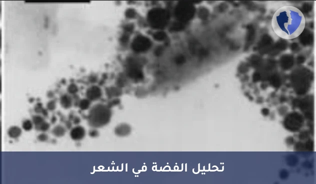 تحليل الفضة في الشعر (Silver) - تحليل الفضة في الشعر