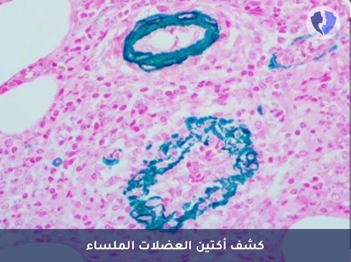 تحليل الكيمياء النسيجية المناعية لأكتين العضلات الملساء (SMA) - كشف أورام العضلات الملساء
