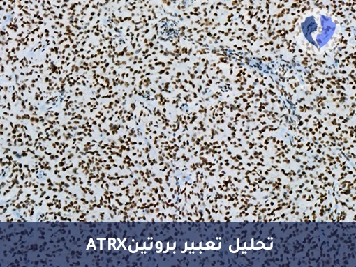 تحليل الكيمياء النسيجية المناعية لبروتين (ATRX) - فحص ATRX لتشخيص أورام الدماغ