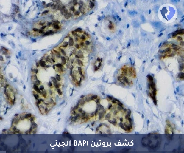 تحليل الكيمياء النسيجية المناعية لبروتين (BAP1) - فحص طفرة BAP1 للأورام