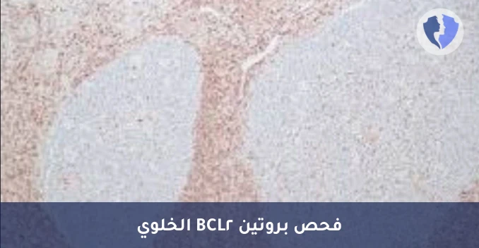 تحليل الكيمياء النسيجية المناعية لبروتين (BCL2) - فحص BCL2 لتصنيف الأورام اللمفاوية