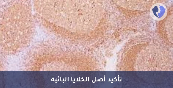 تحليل الكيمياء النسيجية المناعية لبروتين (CD79A) - فحص أورام الخلايا البائية