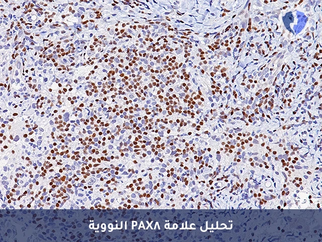 تحليل الكيمياء النسيجية المناعية لبروتين (PAX8) - تحديد مصدر الأورام السرطانية