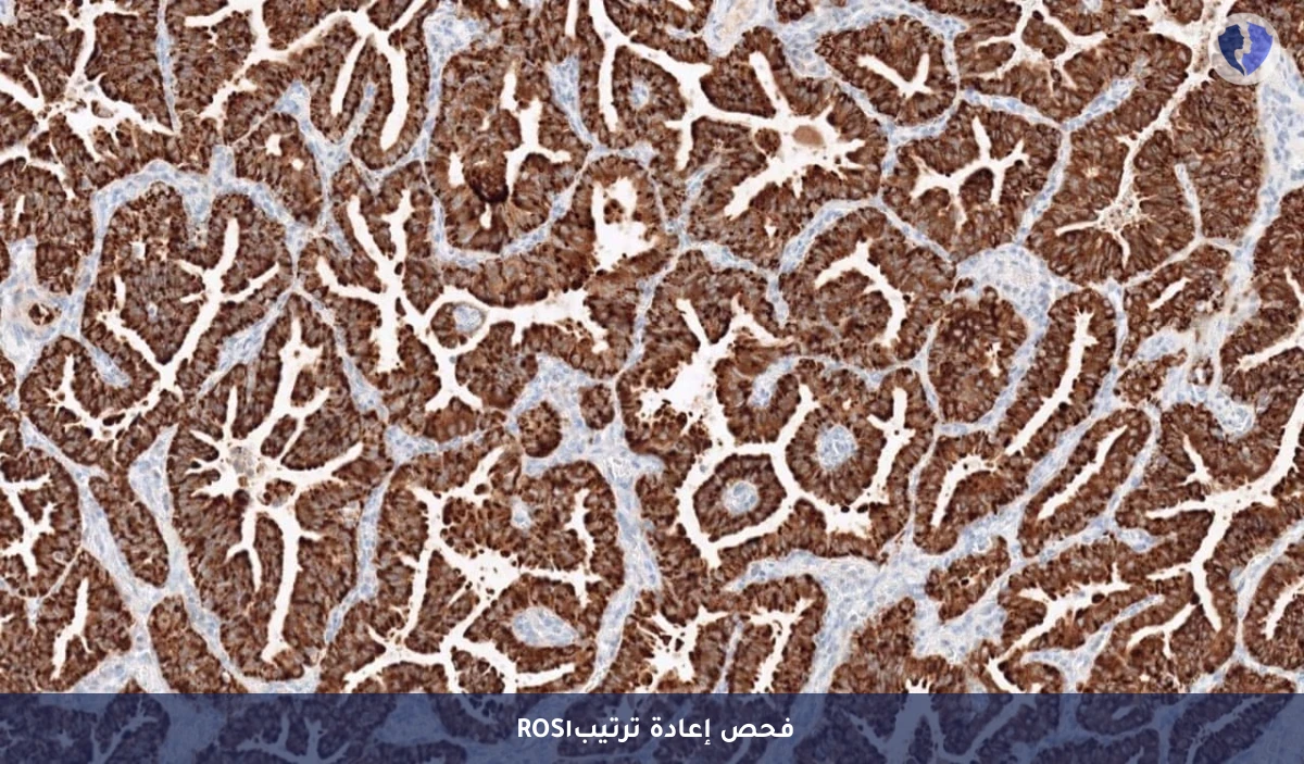 تحليل الكيمياء النسيجية المناعية لبروتين (ROS1) - فحص العلاج الموجه للرئة