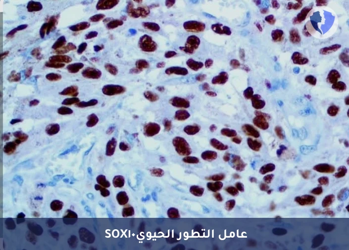 تحليل الكيمياء النسيجية المناعية لبروتين (SOX10) - فحص أورام الجلد والأعصاب