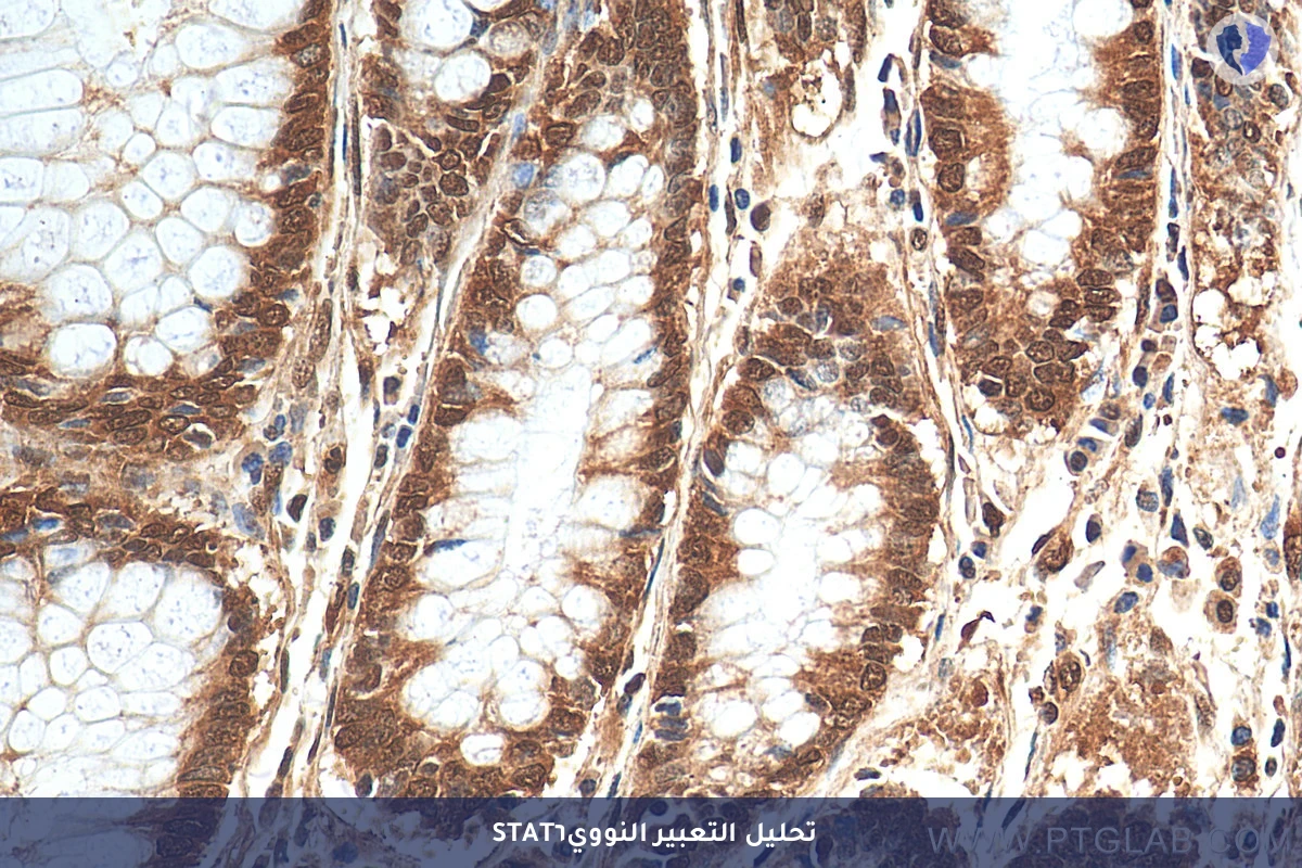 تحليل الكيمياء النسيجية المناعية لبروتين (STAT6) - تشخيص الورم الليفي المنفرد