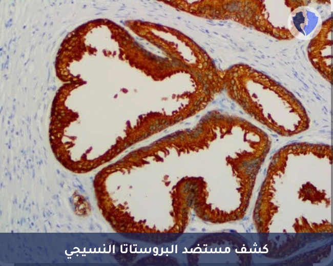 تحليل الكيمياء النسيجية المناعية للمستضد البروستاتي النوعي (PSA) - تأكيد مصدر ورم البروستاتا