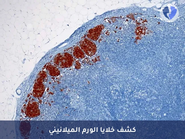تحليل الكيمياء النسيجية المناعية (HMB-45) - التشخيص الدقيق لسرطان الجلد الميلانيني