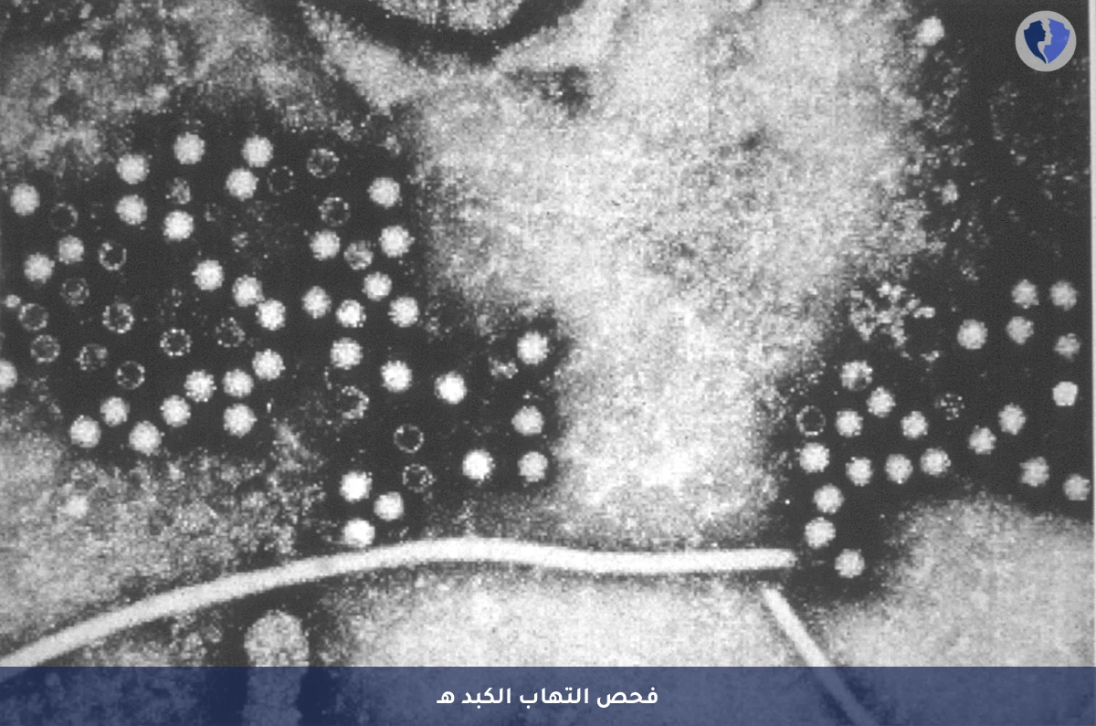 تحليل فيروس التهاب الكبد الوبائي هـ (HEV RNA PCR) - فحص فيروس الكبد E