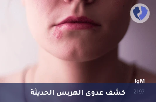 تحليل فيروس الهربس البسيط النوع الثاني (HSV-2 IgM) - فحص الهربس للعدوى الحديثة (IgM)