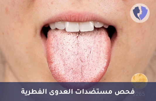 تحليل مستضدات فطر الكانديدا (Candida Antigen) - فحص مستضد الكانديدا الجهازي