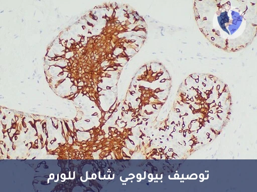 تحليل واستشارة الكيمياء النسيجية المناعية (5 Markers) (IHC) - ملف بيولوجي واستشارة علاجية