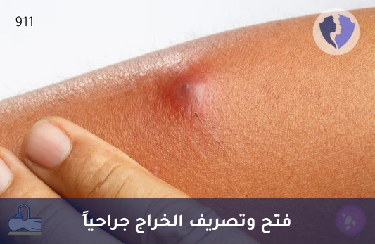 عملية فتح وتصريف خراج تحت التخدير العام - تنظيف وتصريف الخراج