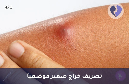 عملية فتح وتصريف خراج صغير تحت التخدير الموضعي - تصريف خراج صغير