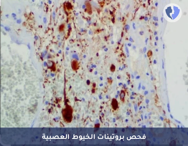 فحص الخيوط العصبية الكيميائي النسيجي المناعي (Neurofilament) - فحص سلامة الخلايا العصبية