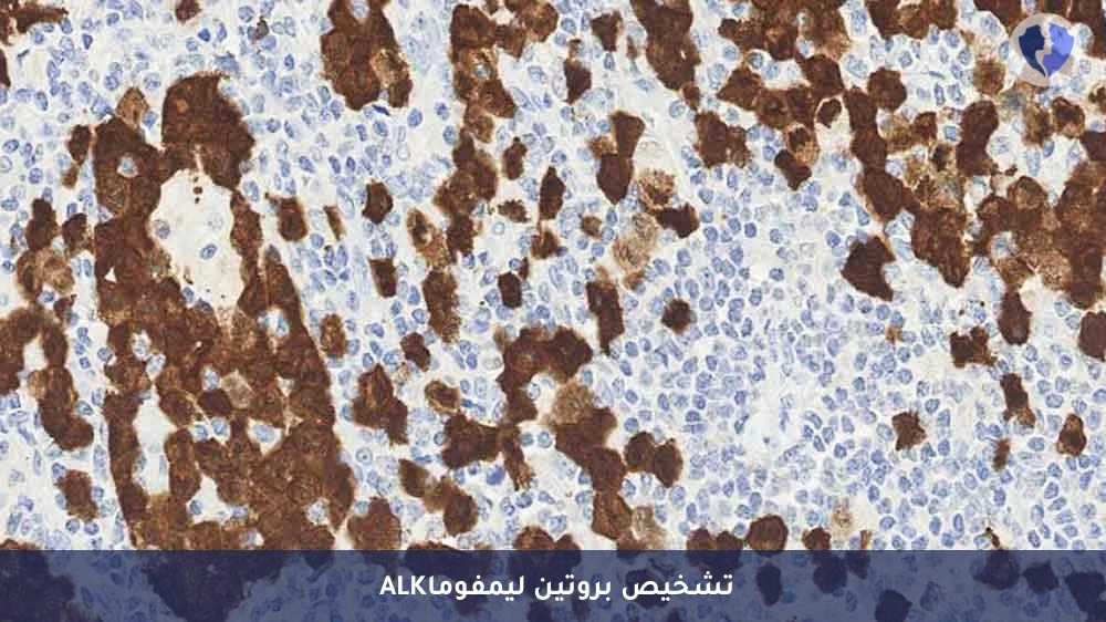 فحص الكيمياء النسيجية المناعية لليمفوما (ALK) - فحص بروتين ALK لليمفوما