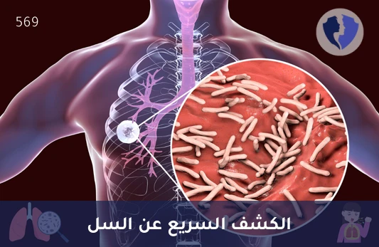 فحص بكتيريا السل بتقنية (Real-Time PCR) - الفحص السريع لمرض السل