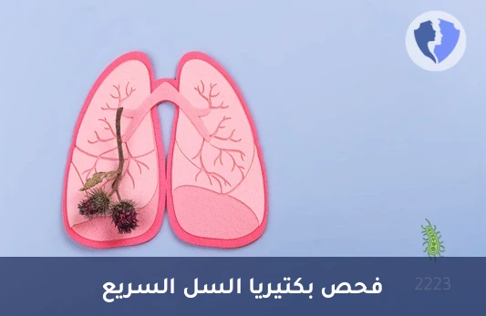 فحص صبغة زيل-نيلسن لبكتيريا السل (ZN Stain) - فحص صبغة السل السريع