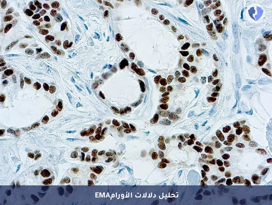فحص كيميائي نسيجي مناعي للمستضد الغشائي الظهاري (EMA) - فحص EMA لتصنيف الأورام