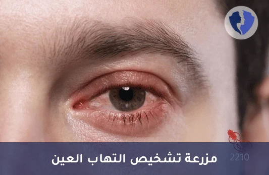مزرعة وحساسية مسحة العين (Eye Swab C/S) - مزرعة مسحة العين
