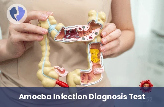 Amoebiasis Antibody Test - Amoebiasis Serology Test