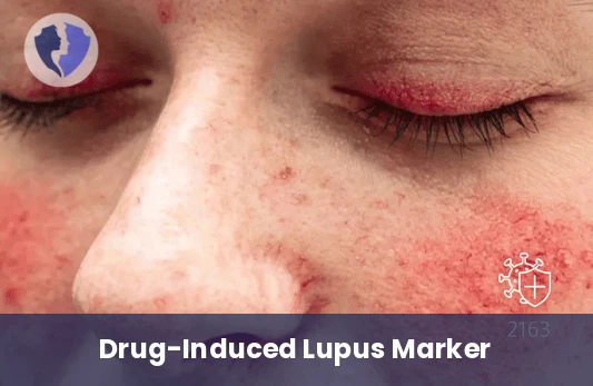 Drug-Induced Lupus Test - Anti-Histone Antibodies Test