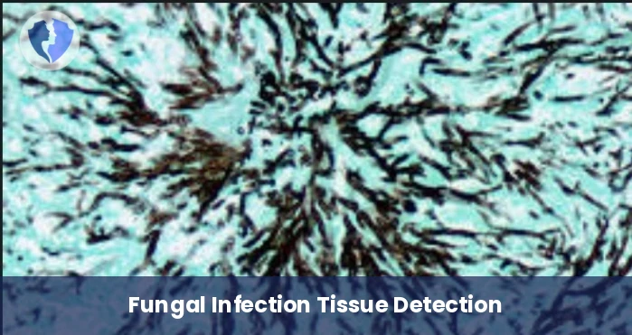 Grocott Silver (GMS) Stain - Grocott Methenamine Silver (GMS) Special Stain