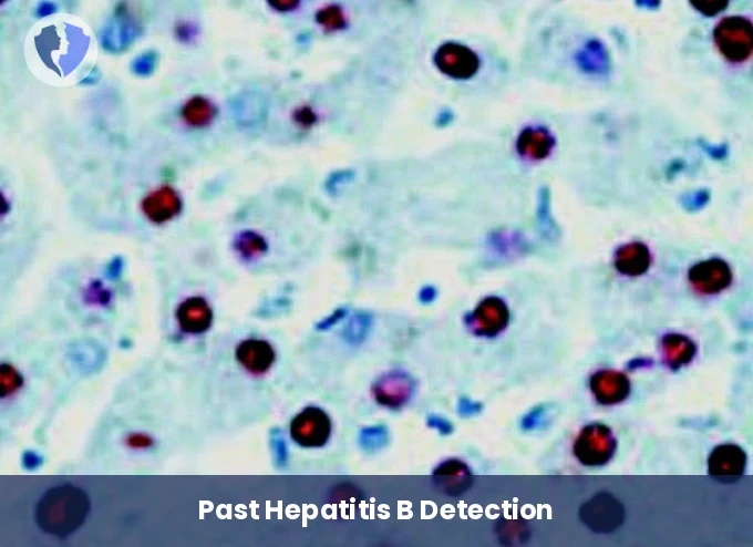 Hepatitis B Core Antibody Test - Hepatitis B Core IgG Antibody Test (HBc IgG)