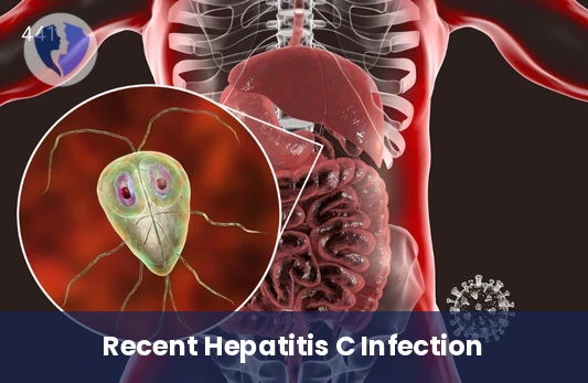 Early Hepatitis C Detection - Hepatitis C Virus IgM Antibody Test