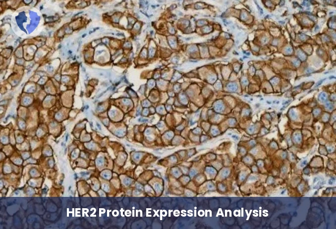 HER2 Breast & Gastric Cancer Test - HER2 Immunohistochemistry Test
