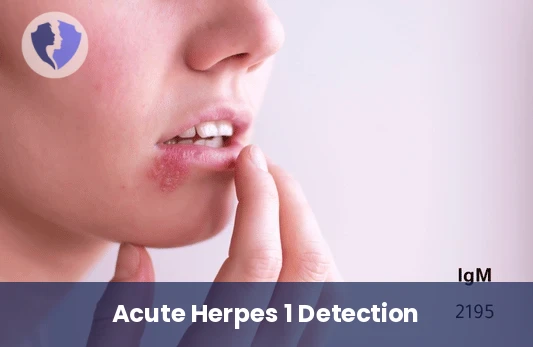 Oral Herpes (HSV-1) IgM Test - Herpes Simplex Virus 1 (HSV-1) IgM Test