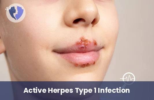 Active HSV-1 Detection Test - Herpes Simplex Virus I IgM Antibody Test