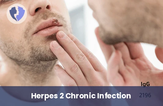 Herpes Type 2 IgG Test - Herpes Simplex Virus Type 2 (HSV-2) IgG Test
