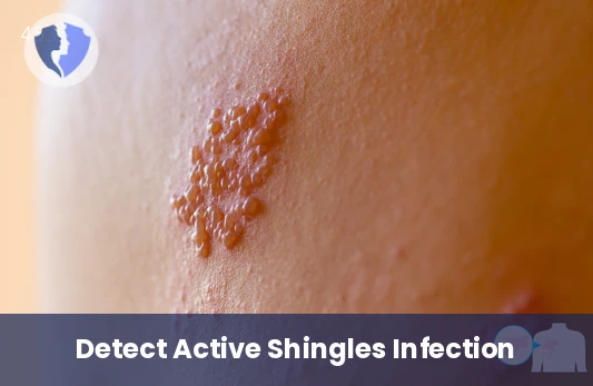 Herpes Zoster IgM Test - Herpes Zoster IgM Antibody Test