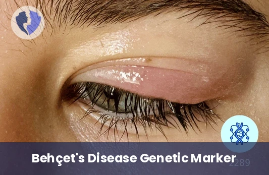 HLA-B51 Genetic Test