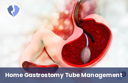 Gastrostomy Tube (PEG) Care - Home Gastrostomy Tube (PEG) Management