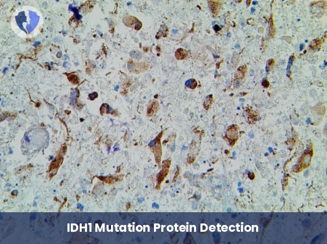 IDH1 Brain Tumor Mutation Test - IDH1 Immunohistochemistry Test