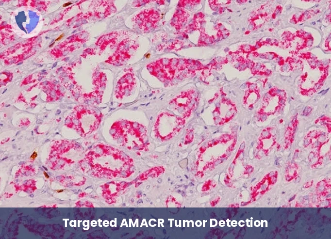 AMACR Test for Prostate Cancer - Immunohistochemistry: AMACR (P504S)